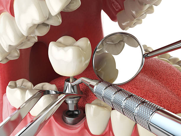 Best Emergency Tooth Extraction in Fennville, MI